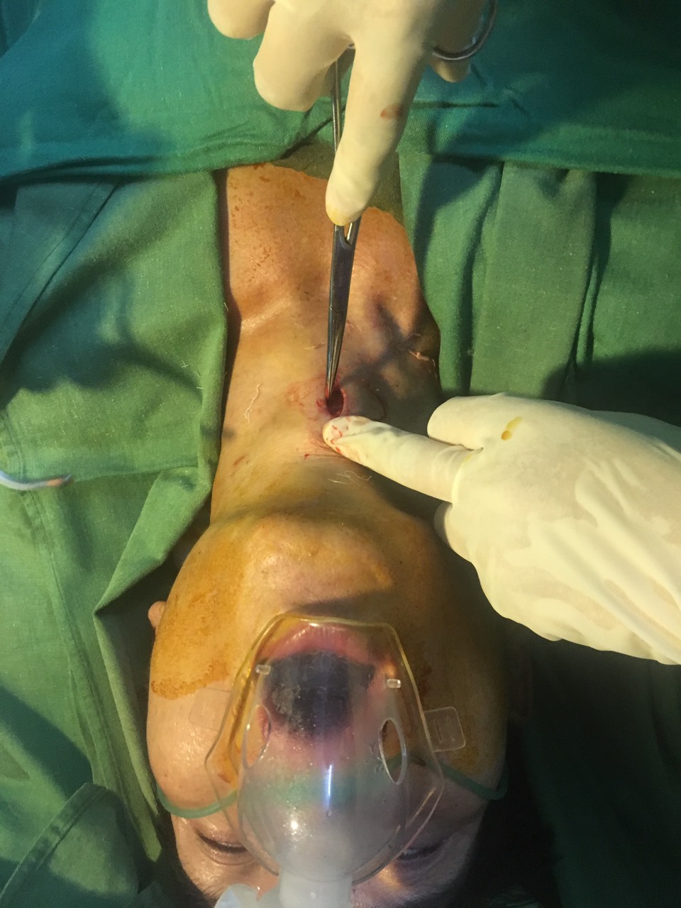 Trung tâm Y tế huyện Than Uyên phẫu thuật mở khí quản cấp cứu bệnh nhân.