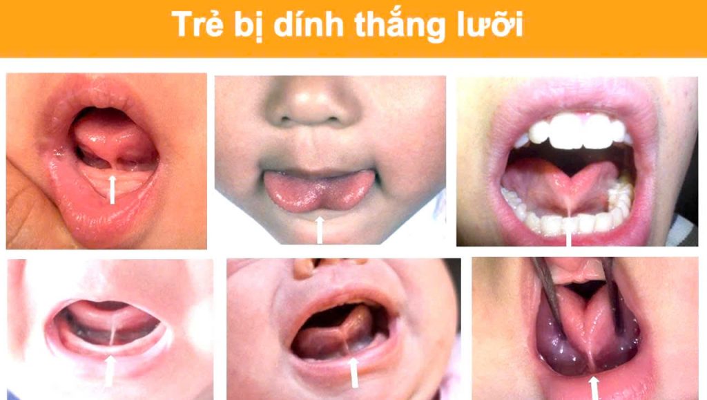 PHÁT HIỆN TRẺ BỊ DÍNH THẮNG LƯỠI NTN